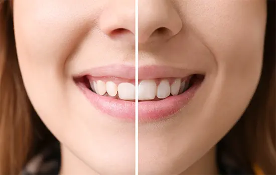 Before and after image showing the transformation of a smile, with restored teeth on the right side.