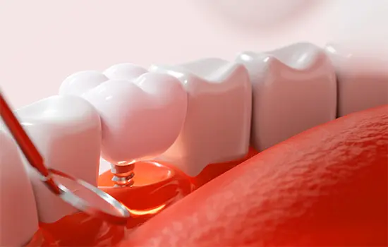 Restorative dental work being done, showing a dental crown being placed on a tooth.